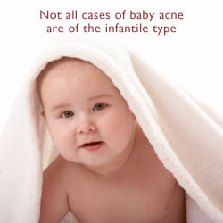 Baby Acne - Not all cases of acne in babies are associated with acne of the infantile clinical type