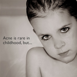 Baby Acne - Not all cases of acne in babies are of the infantile acne type